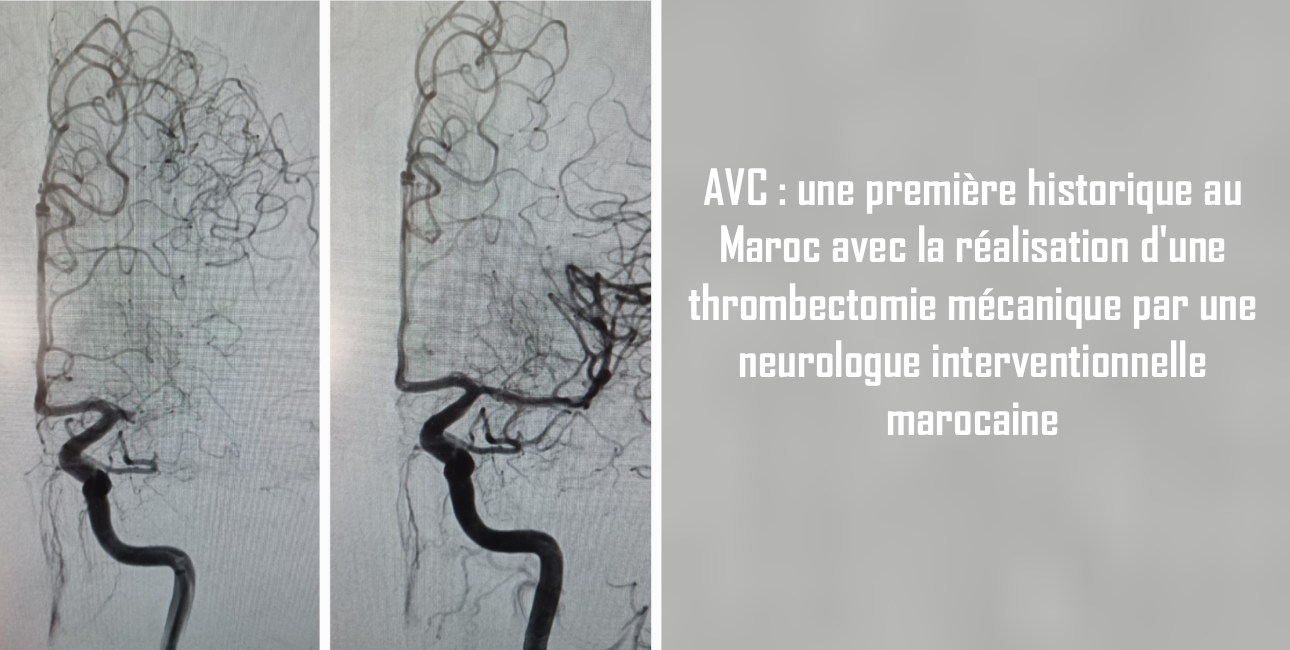 AVC : une première historique au Maroc avec la réalisation d'une thrombectomie mécanique par une neurologue interventionnelle marocaine