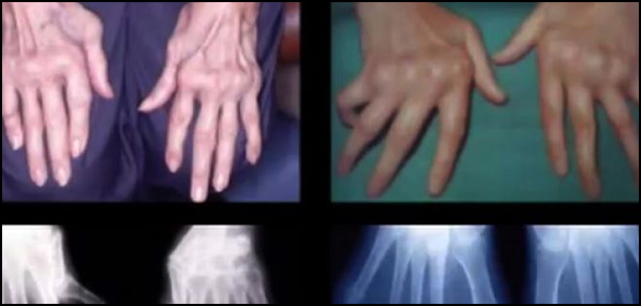 La polyarthrite rhumatoïde, maladie rhumatismale, n’est-t-elle plus aussi handicapante au Maghreb ?